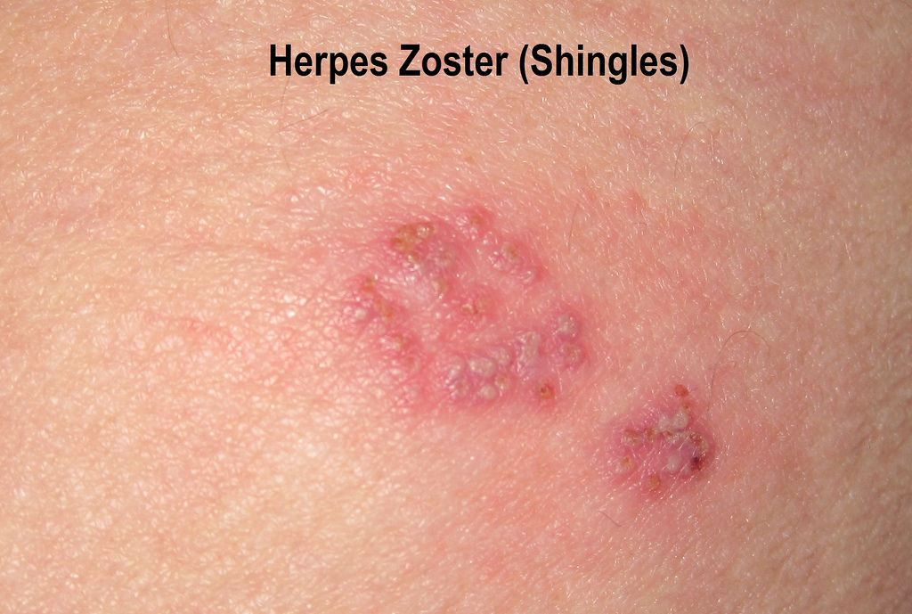 Shingles | Overview | Herpes Zoster | CDC